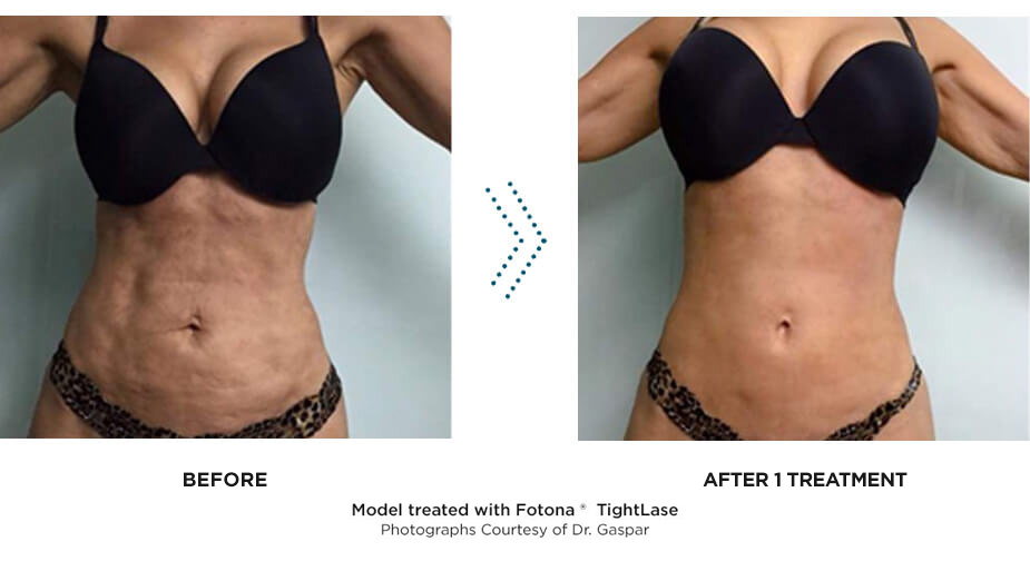 What are the Benefits of Non-Surgical Body Contouring?, Kansas City  Non-Surgical Body Contouring treatment