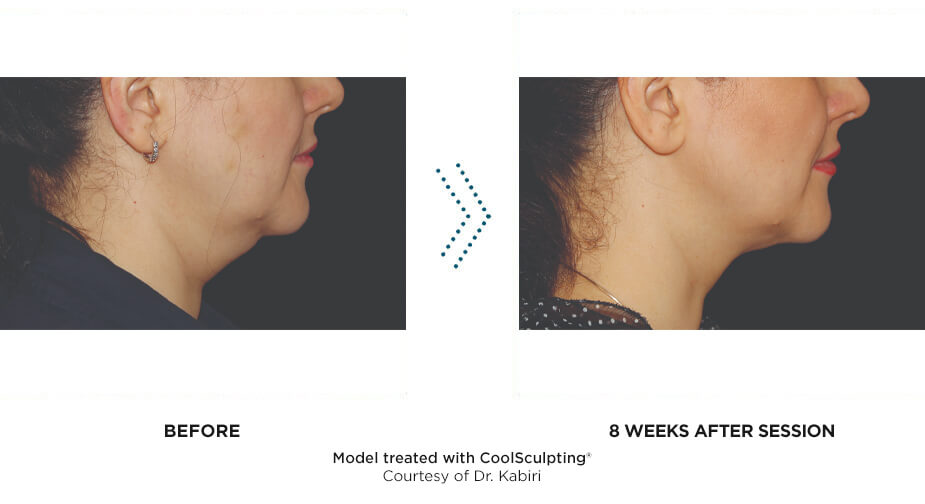 Non-Surgical Fat Reduction/Body Contouring - AMNI - Aesthetic